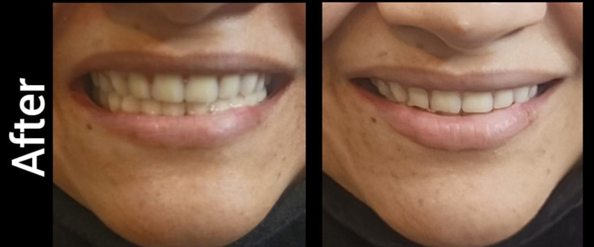 Professional Dental Treatment - Scaling and Polishing Karachi