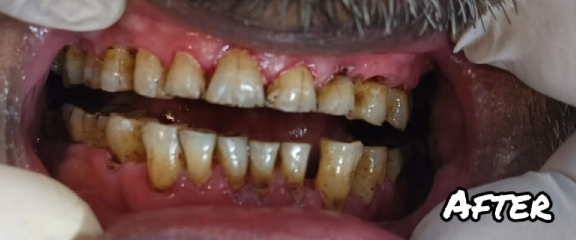 Root Canal Treatment - Painless Dental Care Karachi